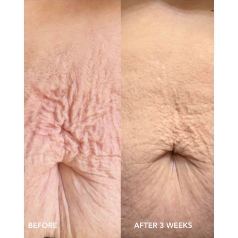 VUL body BA w3 tummy VOL.U.LIFT™ BODY pinguldav kehakreem